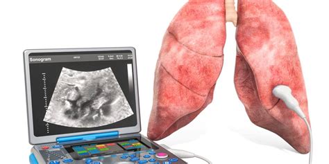 Ultrasound Technique Offers More Precise, Quantified Assessments of Lung Health - Axis Imaging News