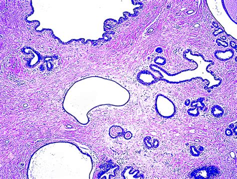 Pathology Outlines - Hamartoma