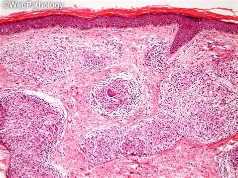 Webpathology.com: A Collection of Surgical Pathology Images