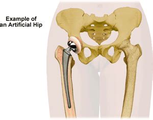 Extending the Life of Your Artificial Hip | AOSMI