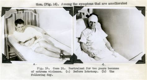 15 Lobotomy Patients Before And After Their Procedure