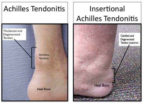 Chronic Achilles Tendon Problems | Murdoch Orthopaedic Clinic