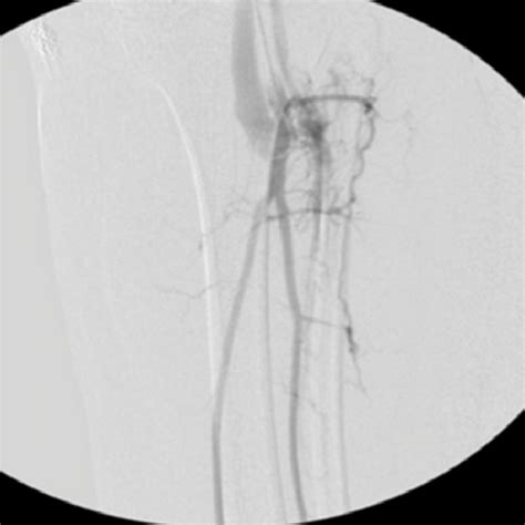 Angiogram of the posterior tibial artery in (A) anteroposterior and (B)... | Download Scientific ...