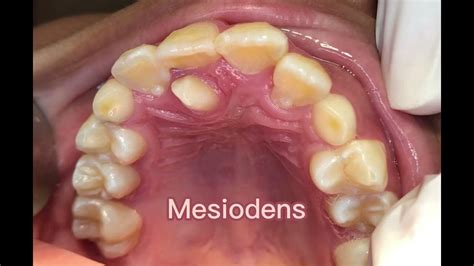 Supernumerary tooth extraction (Mesiodens) - YouTube