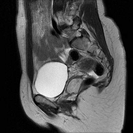 Gartner Duct Cyst Radiopaedia