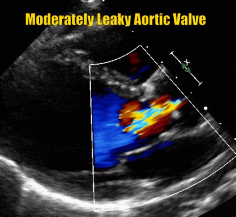 Aortic Regurgitation – A Leaky Aortic Valve • MyHeart