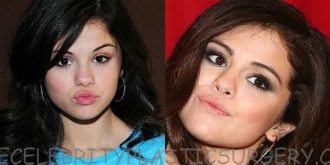 selena-gomez-botox-injections-1 | Selena Gomez boobs job bef… | Flickr