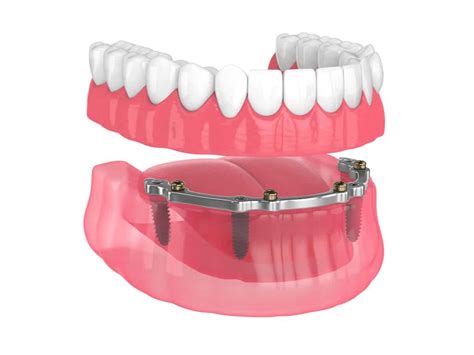 What Are Overdentures? Are You A Good Candidate?