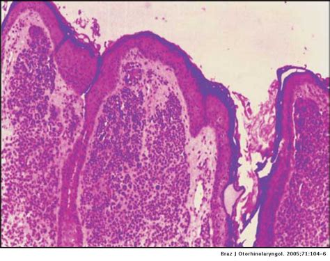 Intradermal melanocytic nevus of the external auditory canal | Brazilian Journal of ...