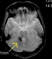 Chronic Trauma with Diffuse Axonal Injury-MRI - Sumer's Radiology Blog