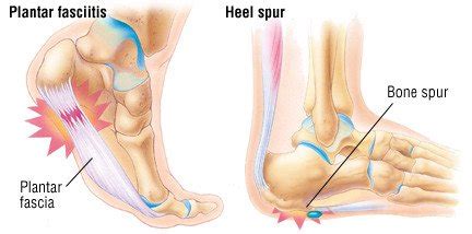 Heel Pain Guide: Causes, Symptoms and Treatment Options