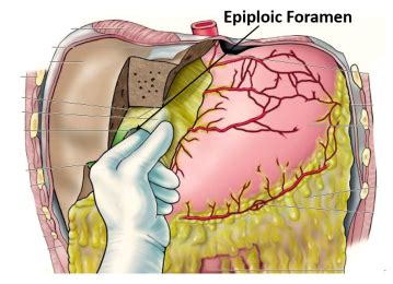 Lesser Sac and Epiploic Foramen , bouundaries and applied aspects , Anatomy QA