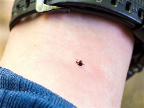 Tick bite rash – how to recognize the symptoms, treatment tips