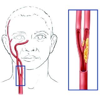 1. Carotid artery and plaque formation. The common carotid artery... | Download Scientific Diagram