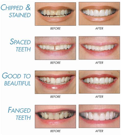 Maggie Kleem DDS before and after dental cosmetic information Olmsted Falls - MAGGIE A. KLEEM, DDS