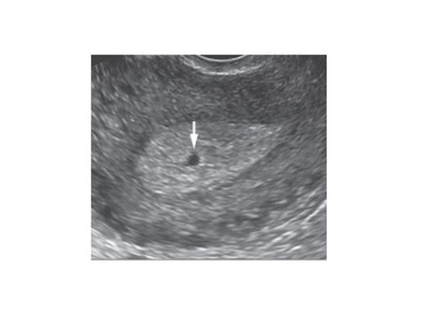 Early pregnancy ultrasound -- Normal pregnancy