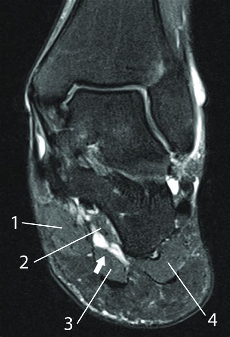 Foot Muscles Mri - Baxter S Nerve Entrapment Diagnosis Treatment Injection Surgery - By muhammad ...