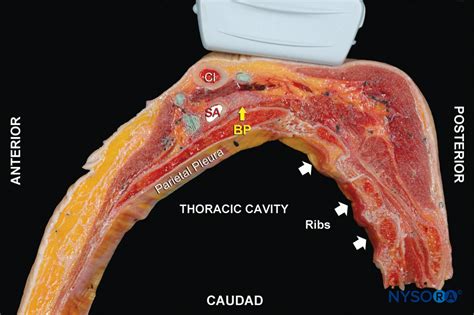 Ultrasound-Guided Supraclavicular Brachial Plexus Nerve Block - NYSORA