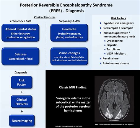 Posterior Reversible Encephalopathy Syndrome In Year Old | SexiezPicz ...