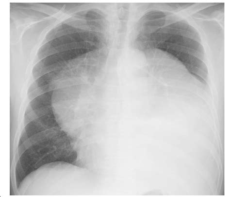 Chest X-ray film showing a huge mediastinal tumor | Download Scientific ...