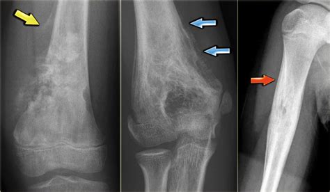 ON - RADIOLOGY: What is Periosteal reaction? it`s types? And how it is helpful in diagnosisby it ...