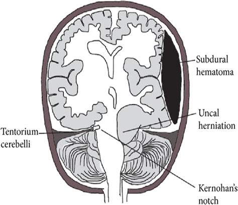 Schematic representation of Kernohan–Woltman notch phenomenon.5,6 | Download Scientific Diagram