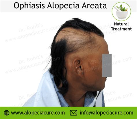 Ophiasis Alopecia Areata