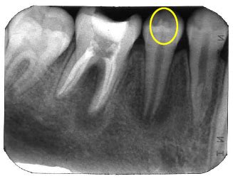 Dens Evaginatus – Dr. G's Toothpix