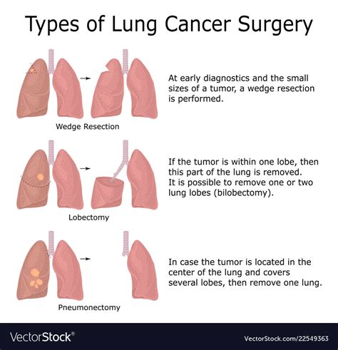 Types of lung cancer surgery Royalty Free Vector Image