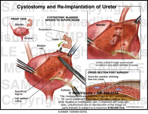 Cystostomy and Re-Implantation of Ureter Medical Exhibit