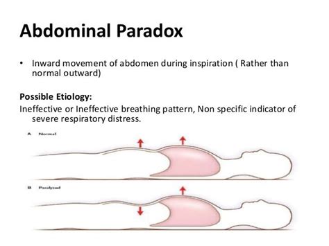 Image result for abdominal paradoxical breathing | Paradox, Abdominal, Abdomen