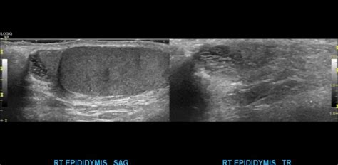 Torsed Appendix Testis – Sonographic Tendencies