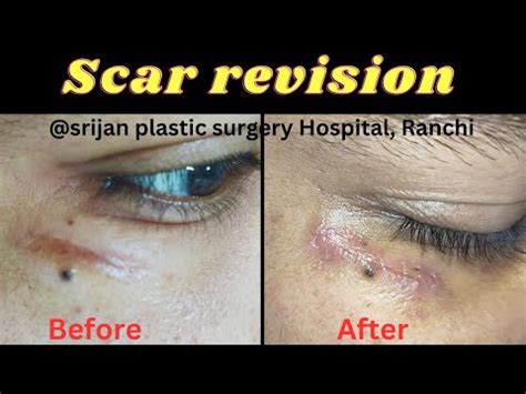 Scar revision surgery - Result after 1 week | Laser scar revision surgery| Scar treatment near ...