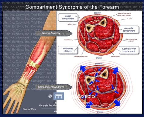 Compartment Syndrome of the Forearm - TrialQuest Inc.