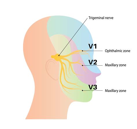 Atypical Trigeminal Neuralgia? - Regenexx