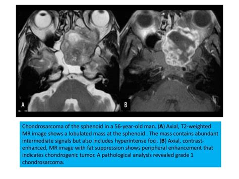 Chondrosarcoma of skull base,Radiology point of view