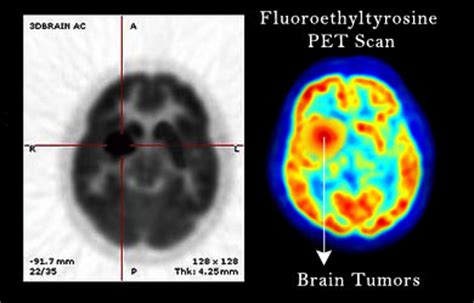 Positron Emission Tomography (PET) Scan - Procedures, Types, Risks