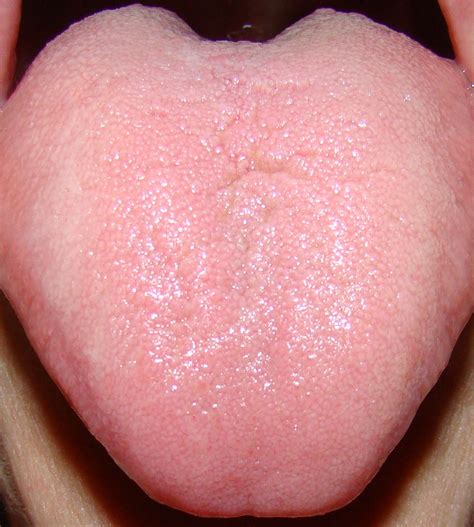 Burning Tongue – Symptoms, Causes and Home Remedies – Saloni Health ...