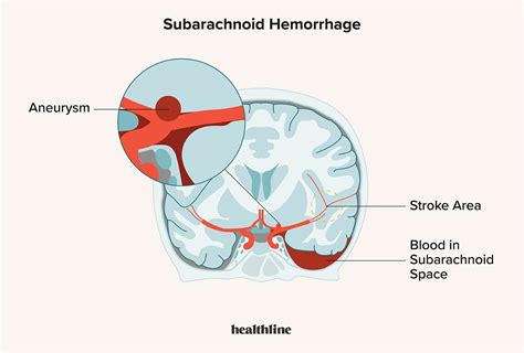 Subarachnoid Hemorrhage: Symptoms, Causes & Risk Factors in 2022 | Subarachnoid hemorrhage ...