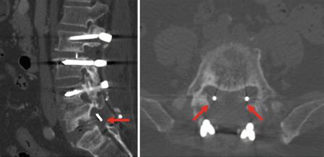 Instrumented PLIF in Lumbar Degenerative Spine: Principles, Indications, Technical Aspects ...