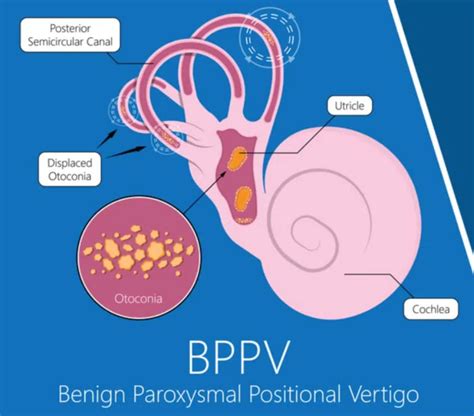 Benign Paroxysmal Positional Vertigo: A Case Study - Physiopedia