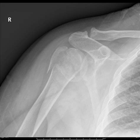 Proximal Humerus Fracture – Core EM