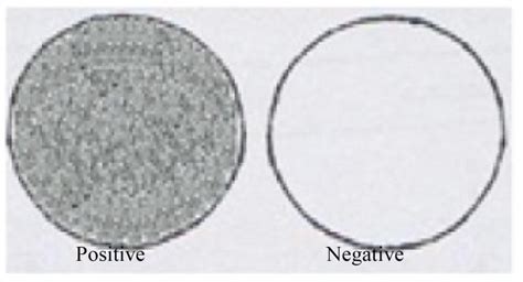 Schematic diagram showing interpretations of gastric aspirate shake test | Download Scientific ...