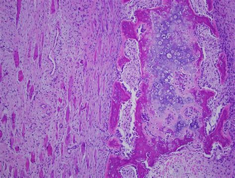 Myositis Ossificans - Pathology - Orthobullets