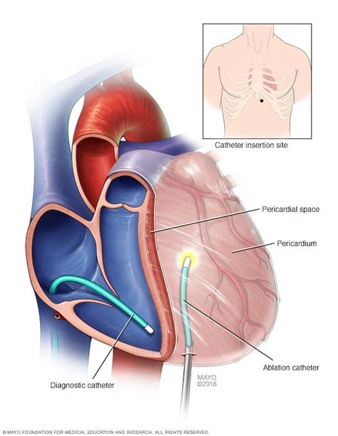 Ventricular tachycardia ablation - Type - Mayo Clinic | Ventricular tachycardia, Implantable ...