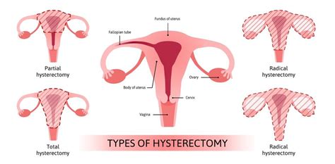 Should I Get a Hysterectomy for Fibroid Removal?| Fibroid Institute Texas