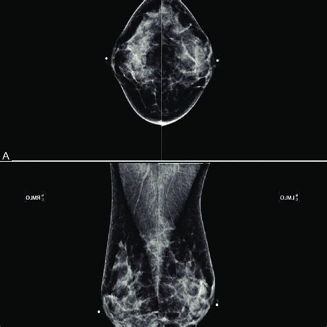 (A and B): (A) Bilateral Mammogram Cranio Caudal viewExtremely dense... | Download High ...