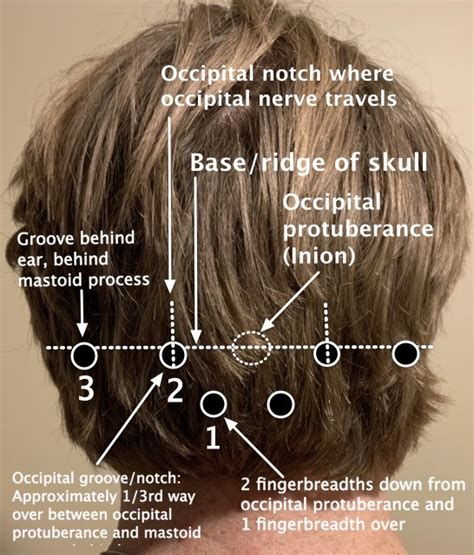 Occipital Neuralgia: Unveiling Symptoms, Causes, and Effective ...