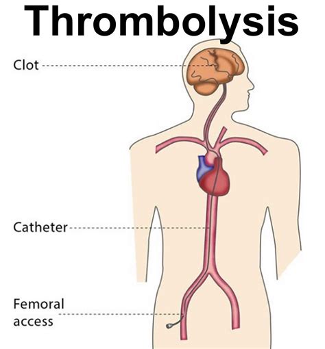 Thrombolysis definition, procedure, catheter directed thrombolysis & risks