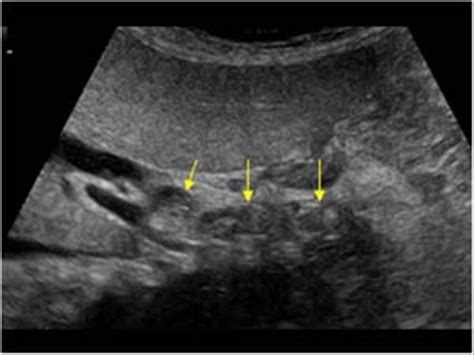 WK 4 BILIARY TREE PATHOLOGY Multiple common bile duct stones ...